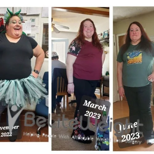 Weight Loss Surgery Gastric Sleeve before and after